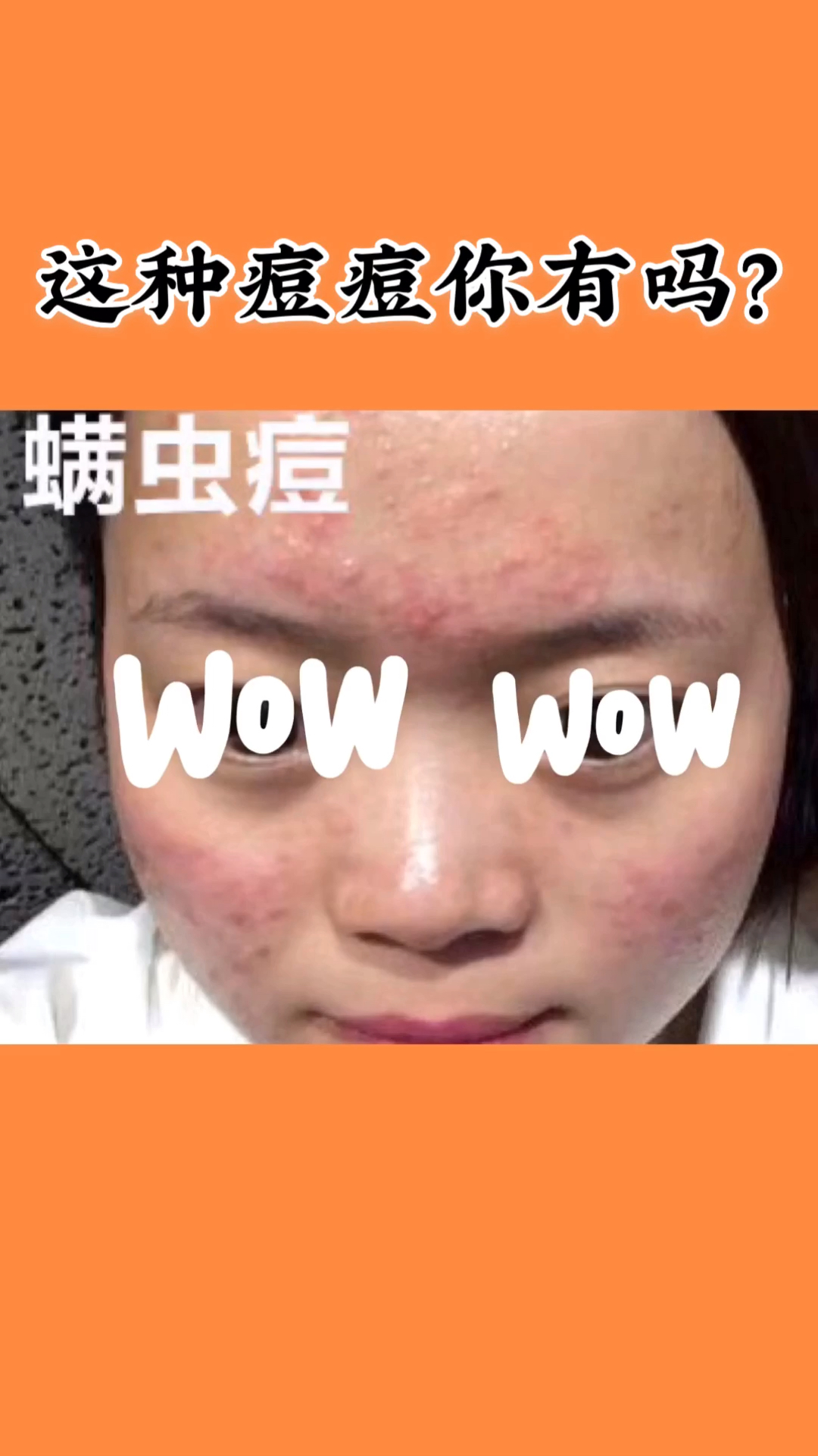 螨虫痘痘#这种螨虫痘你有吗?