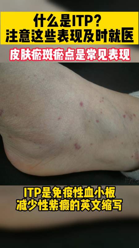生活医疗科普#什么是免疫性血小板减少性紫癜?