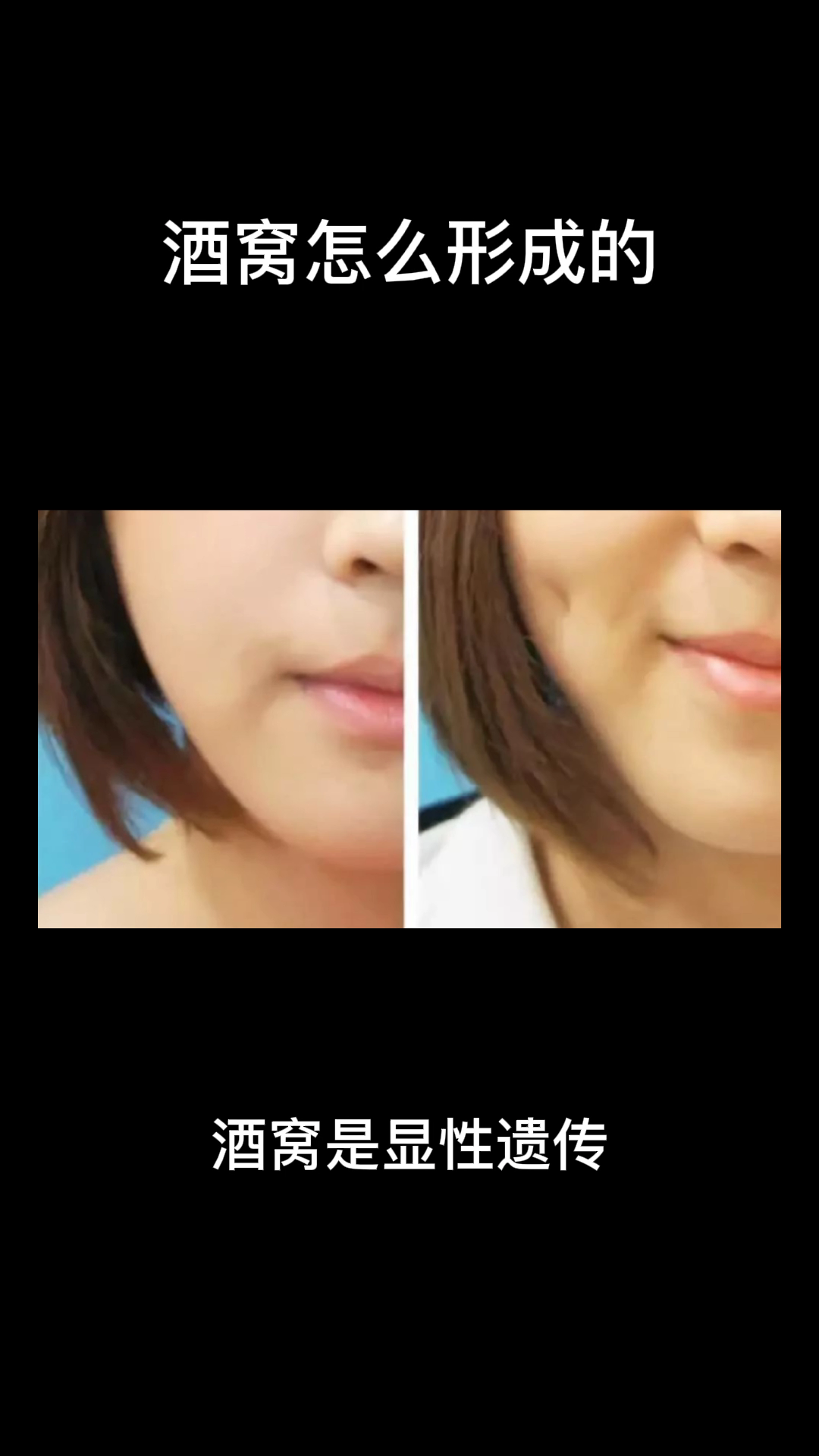 酒窝怎么形成的,你知道了吗?