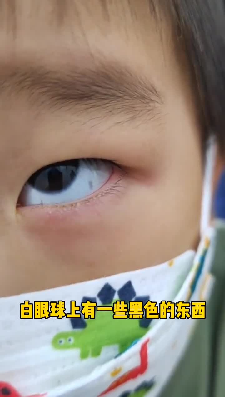 宝宝眼白有黑斑图片图片