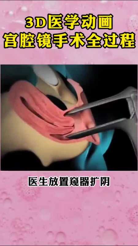 3d医学动画演示宫腔镜手术全过程-度小视