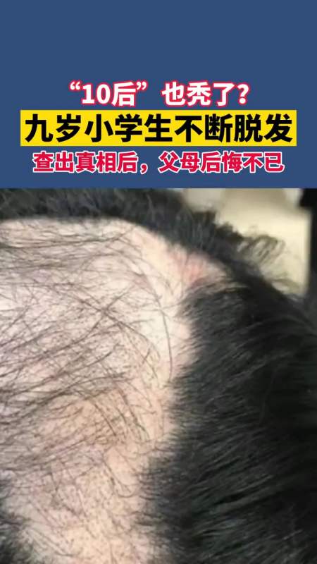 九岁小学生不断脱发,患上"拔毛癖"