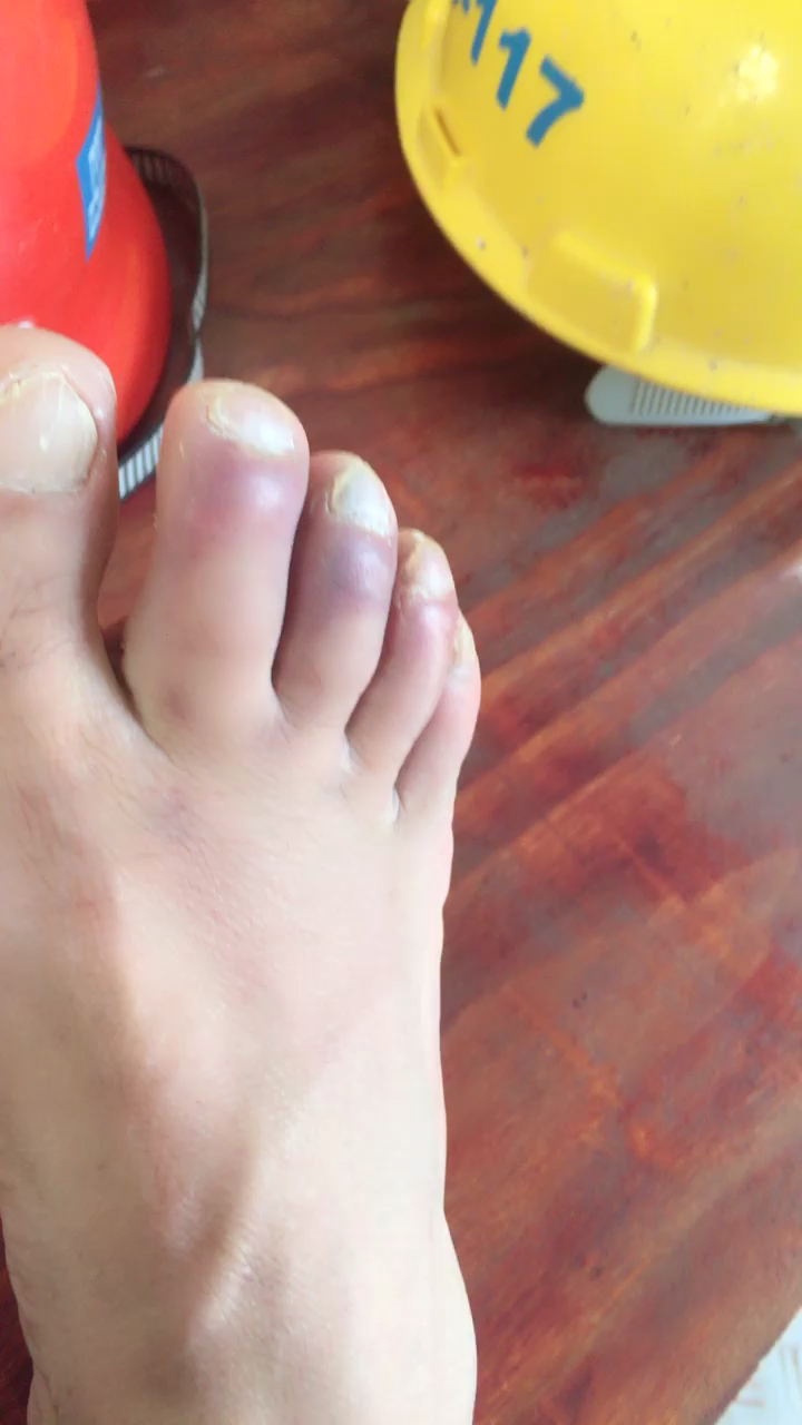 脚被砸成这样,什么时候能好?