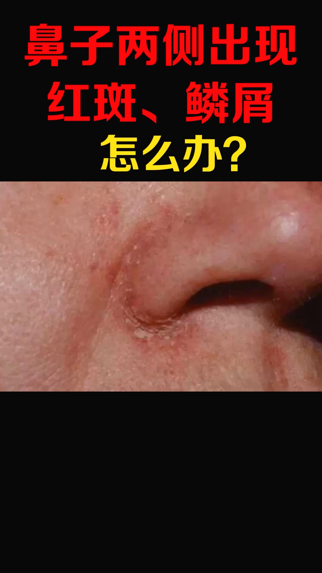 鼻子癣的症状图片图片