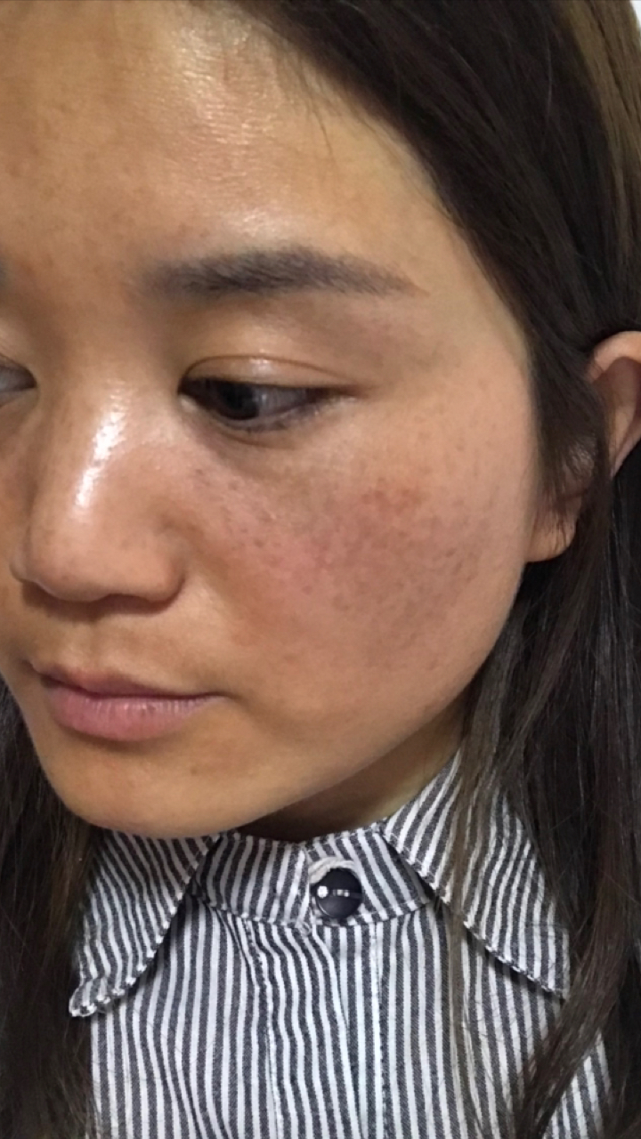 脸上的班点暗黄也同样的原理,击退黑色素,再也不用每天涂厚厚的粉底