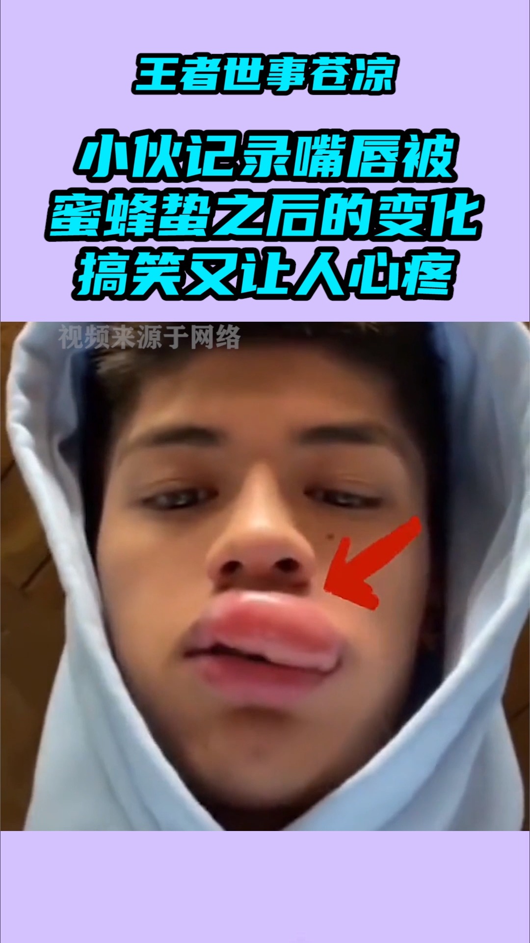 我要上热门#小伙记录嘴唇被蜜蜂蛰之后的变化,搞笑又让人心疼,建议