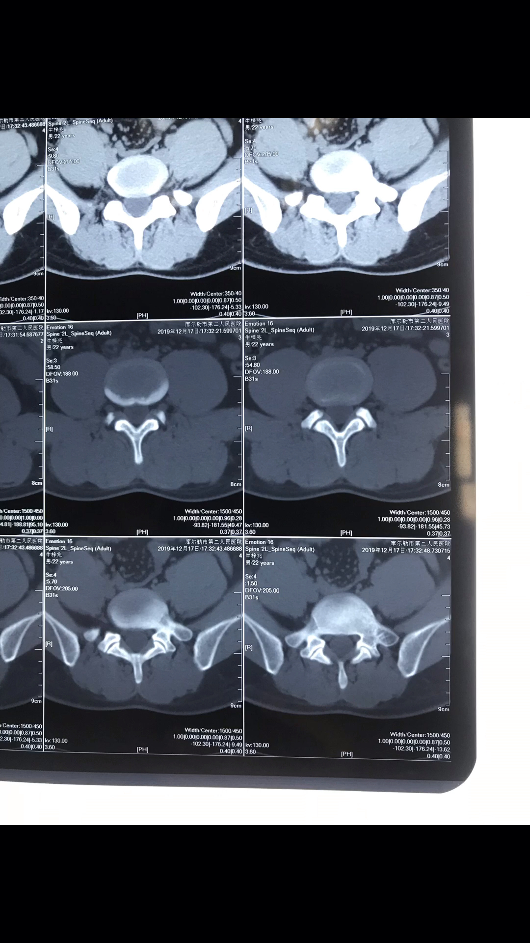 腰椎第五节和骶椎第一节一侧硬膜囊受压-度小视