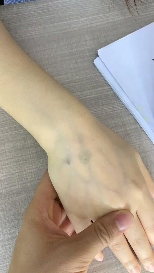 这几天老婆天天打吊针 手都青了 只能用热水帮她泡