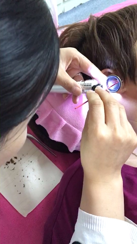 多年来一直受耳结石困扰的患者,今天在咱家无痛取出耳结石,听力恢复!