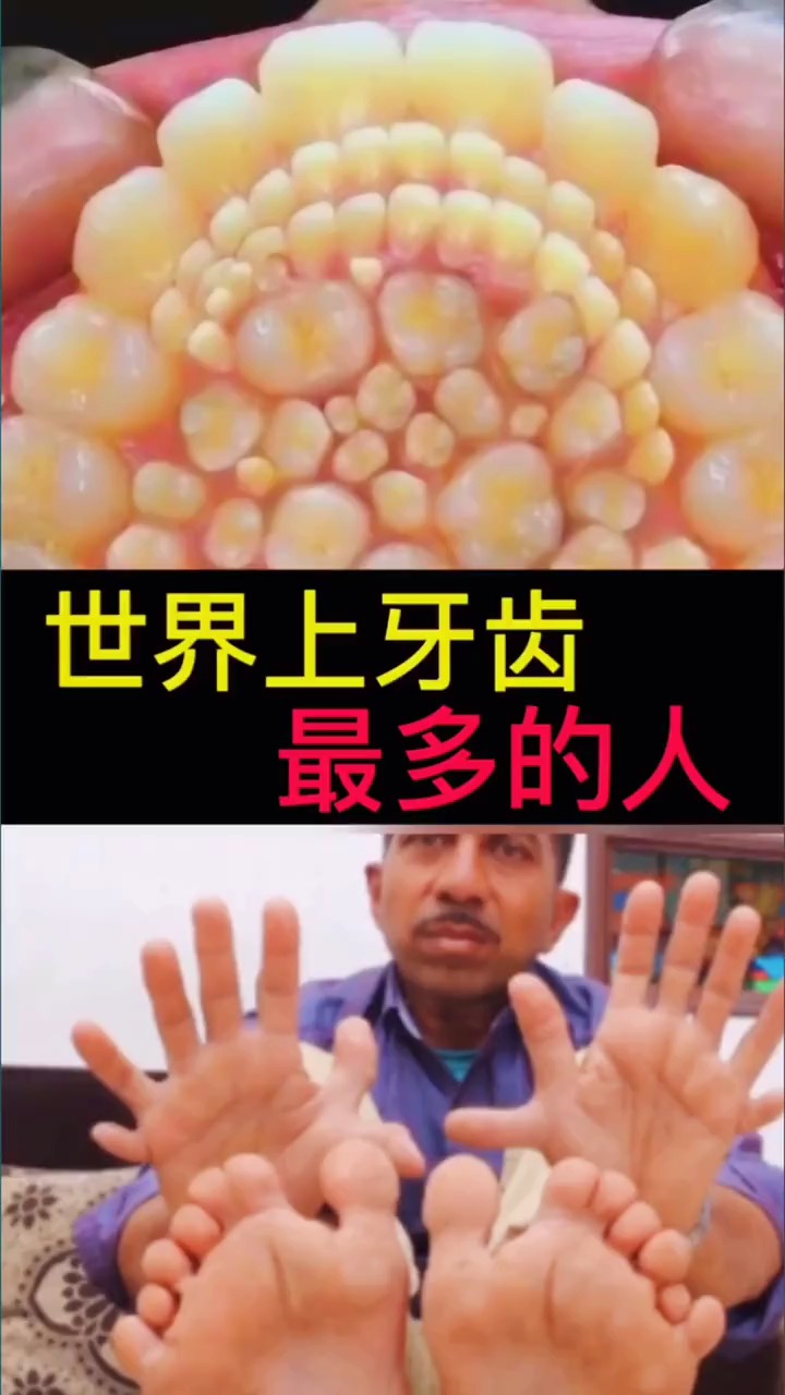 奇闻趣事抢先看#世界上牙齿最多的人