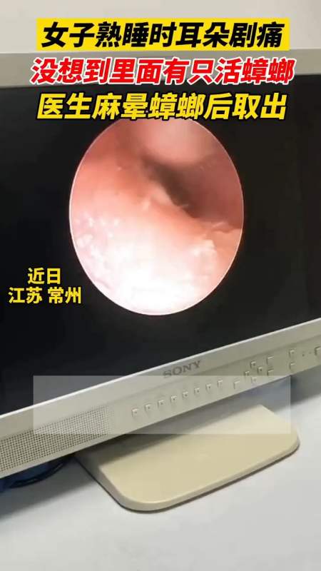 医生提醒:耳朵进异物不要自己掏,有鼓膜穿孔风险.