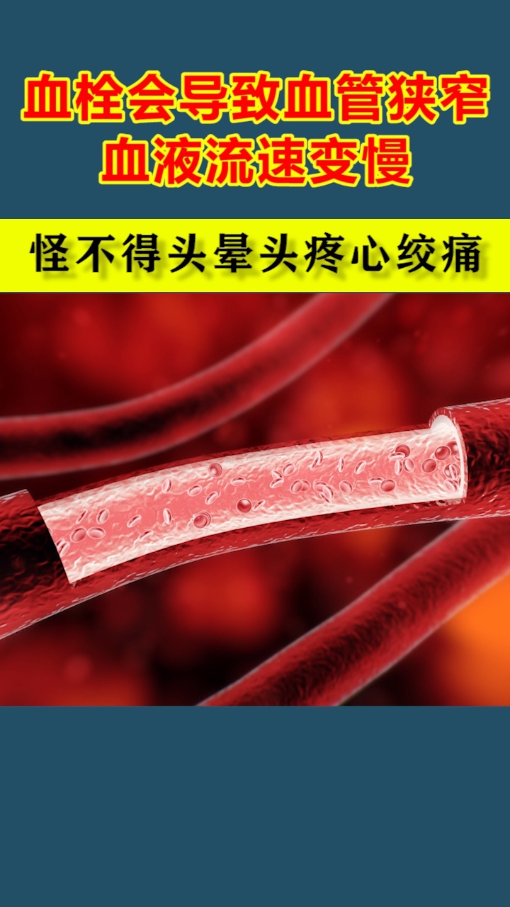 血栓堵塞血管,怪不得你头晕头痛,心绞痛呢