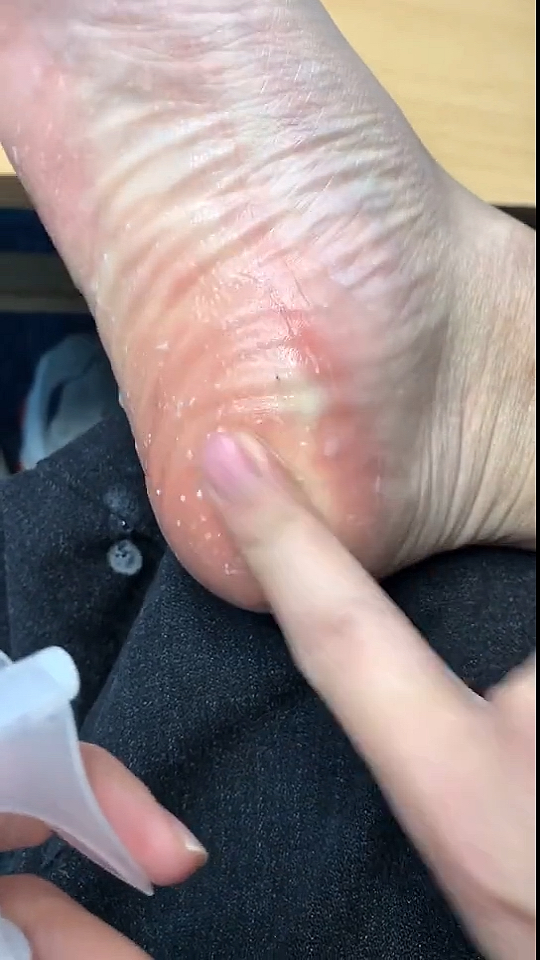 脚后跟的老茧怎么去掉?左下角揭秘!现在脚很光滑