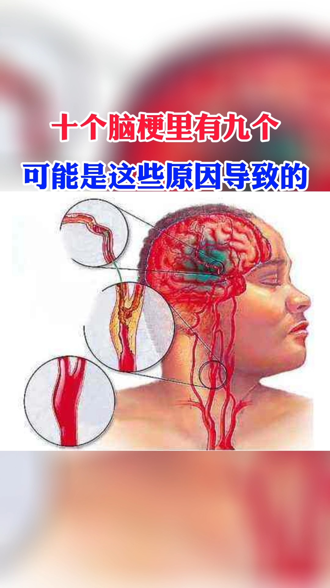 每日健康优选#十个脑梗里有九个可能是这些原因导致的