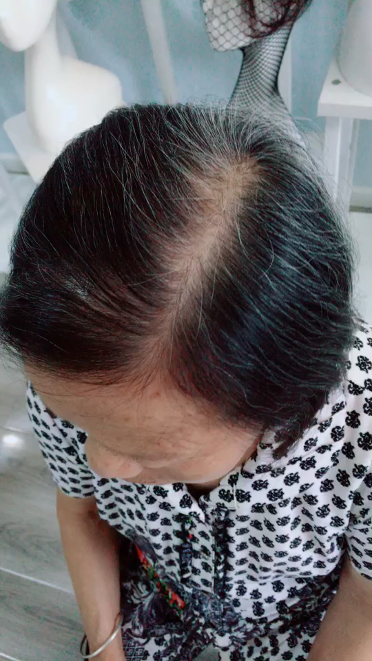 白发,发量少,头顶片解决