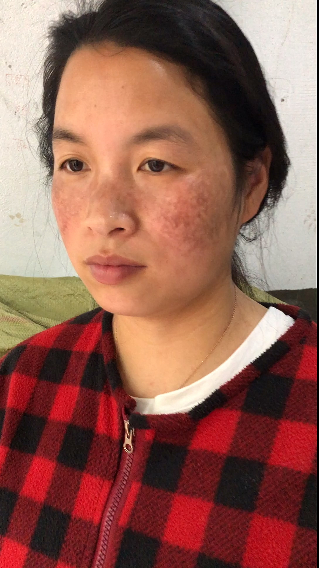 忘不掉那段满脸黑麻子的经历,希望抛弃我的那个你能够看到这个视频