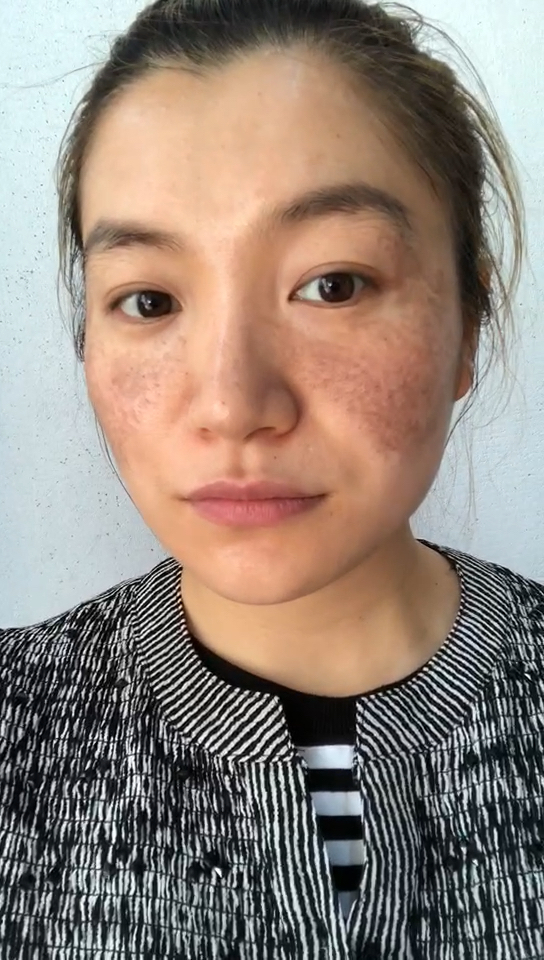 曾经满脸麻子的我被人抛弃.现在的我.非常自信.