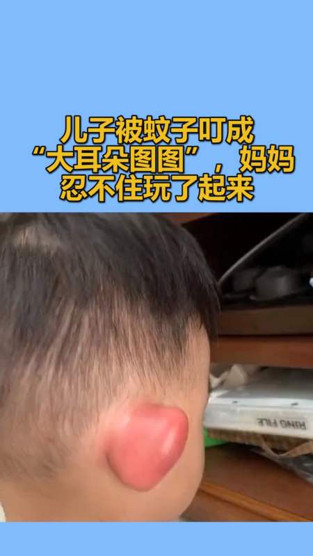 我要上热门#儿子被蚊子叮成"大耳朵图图",妈妈忍不住玩了起来