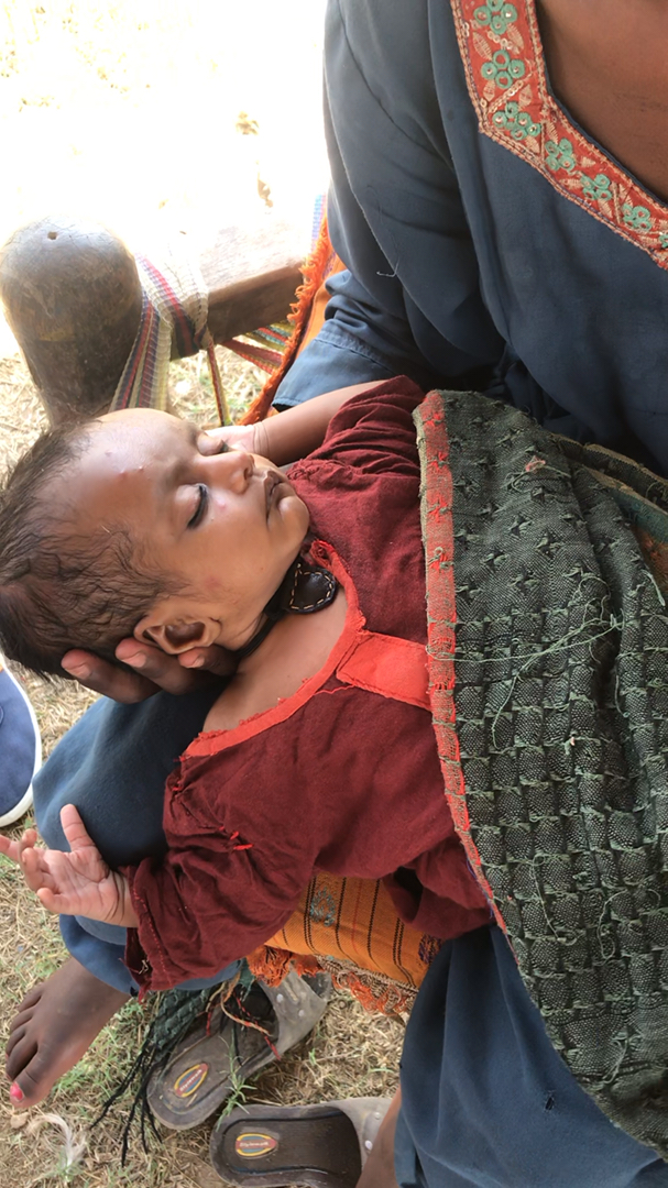 被蚊子叮的满脸疱的巴基斯坦小孩