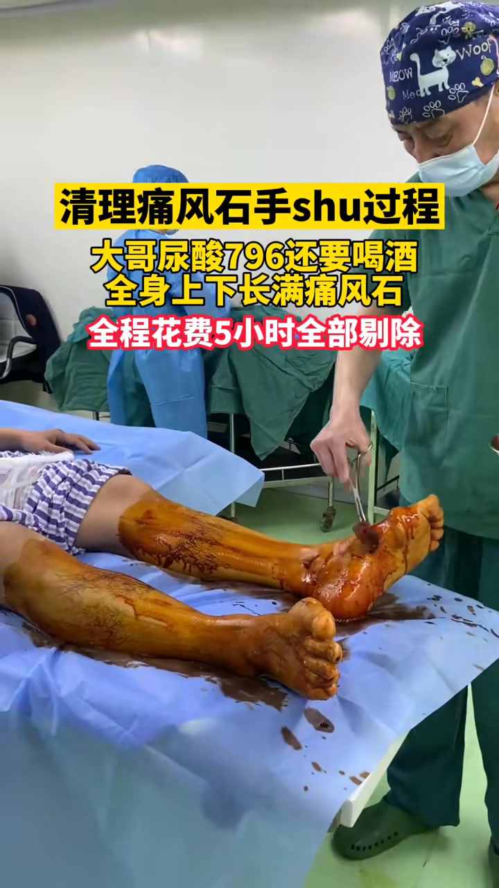 健康痛风石清理过程你们害怕吗