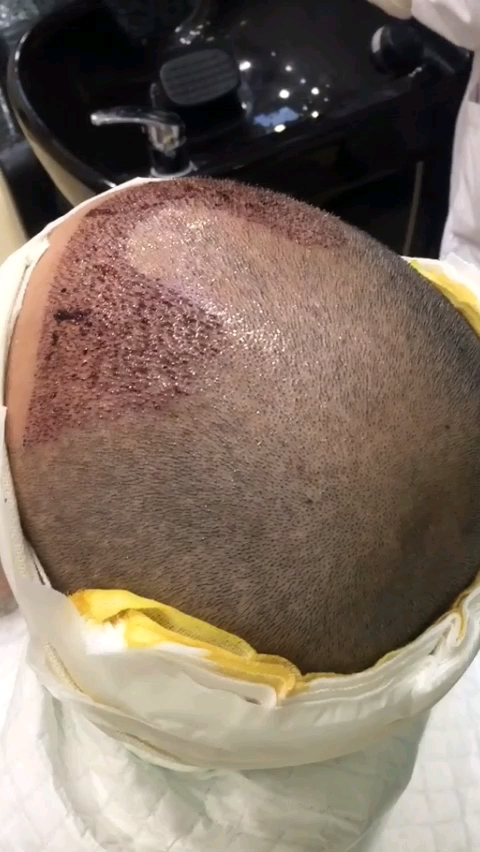 种发第二天,看着害怕,其实不疼的.从此告别单身和自卑!