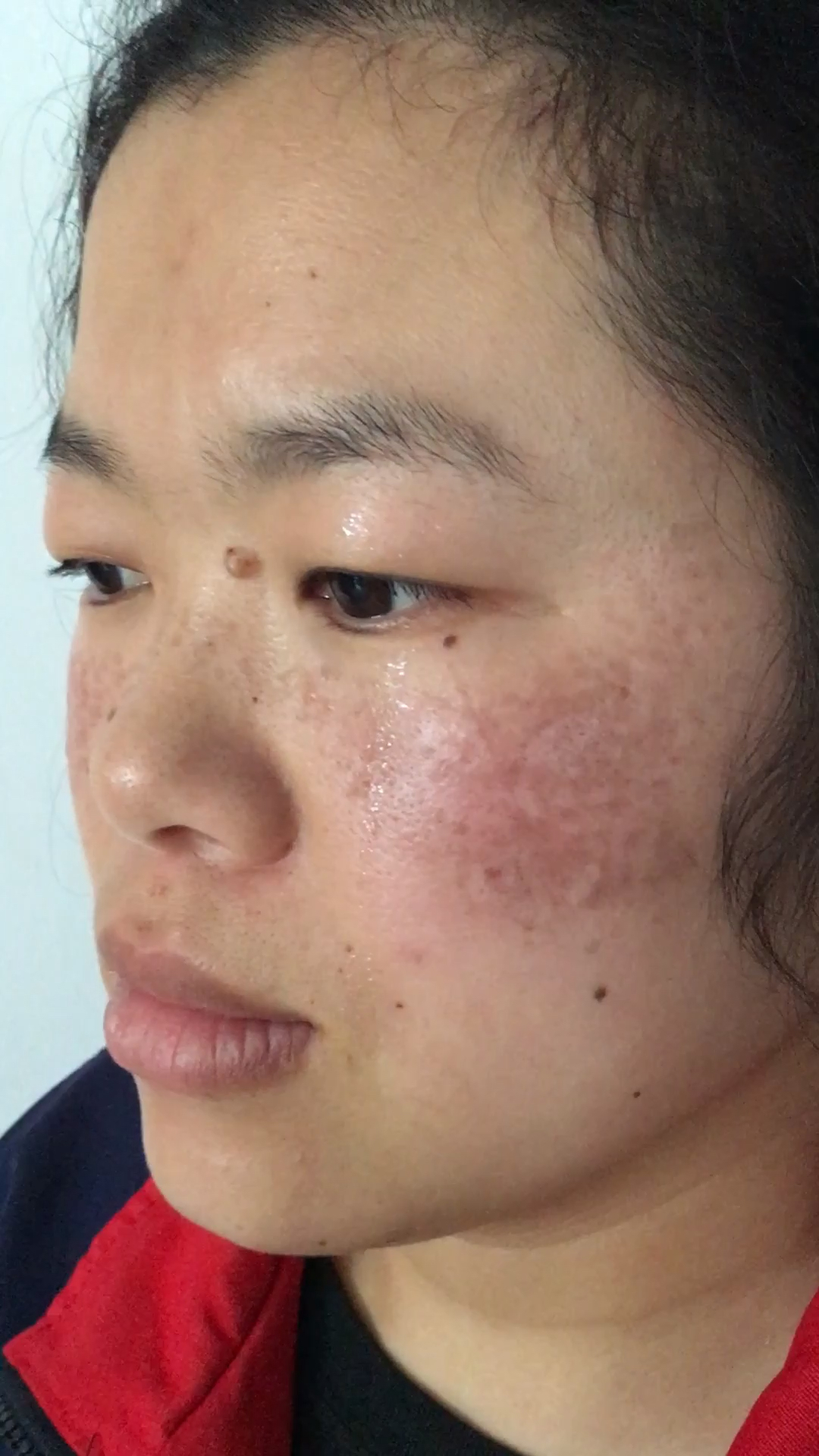 自用4个多月脸上将近10年的班班点点,暗黄粗糙毛孔粗大,痘痘粉刺黑头