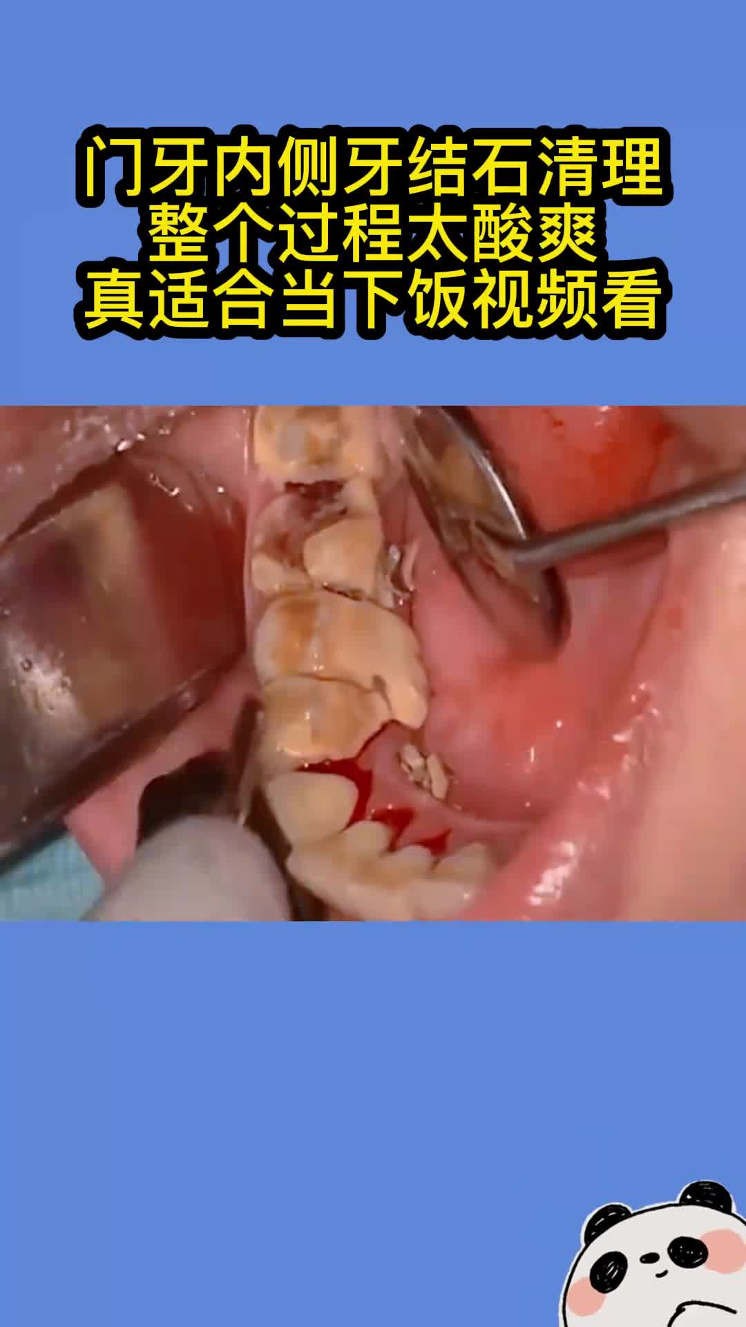 门牙外侧牙结石清理整个过程太酸爽真适合当下饭视频看