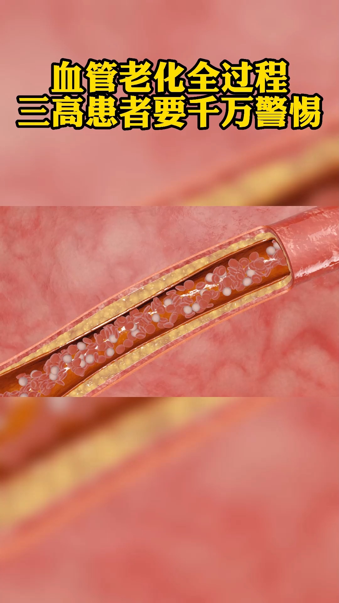 血管老化全过程三高患者要千万警惕