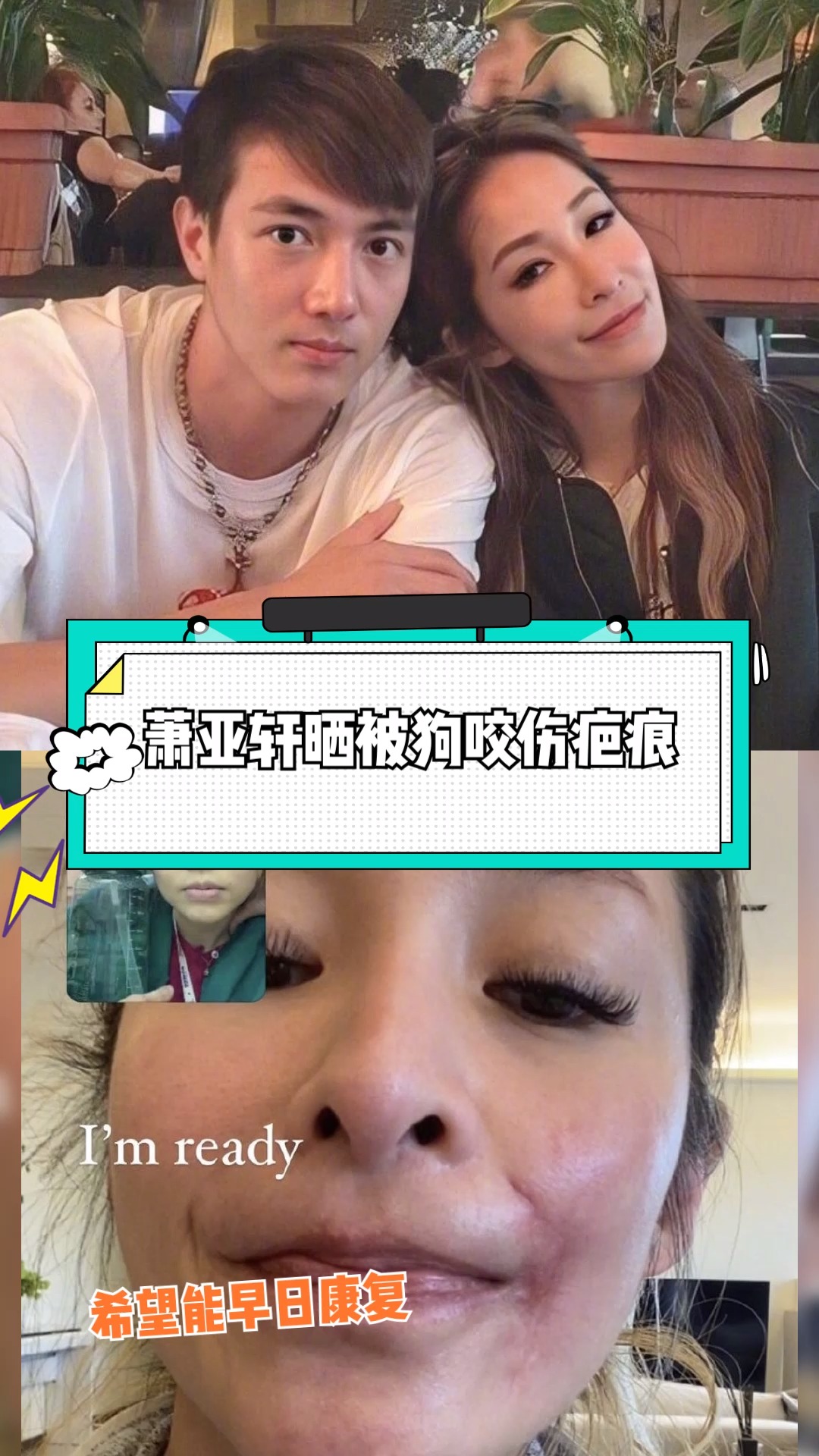 萧亚轩 首度公开被狗咬伤的伤口!右脸疤痕非常明显,希望能早日康复