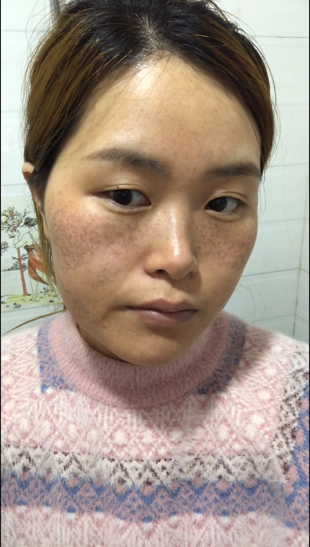 六年的麻子脸.两个多月的改变!