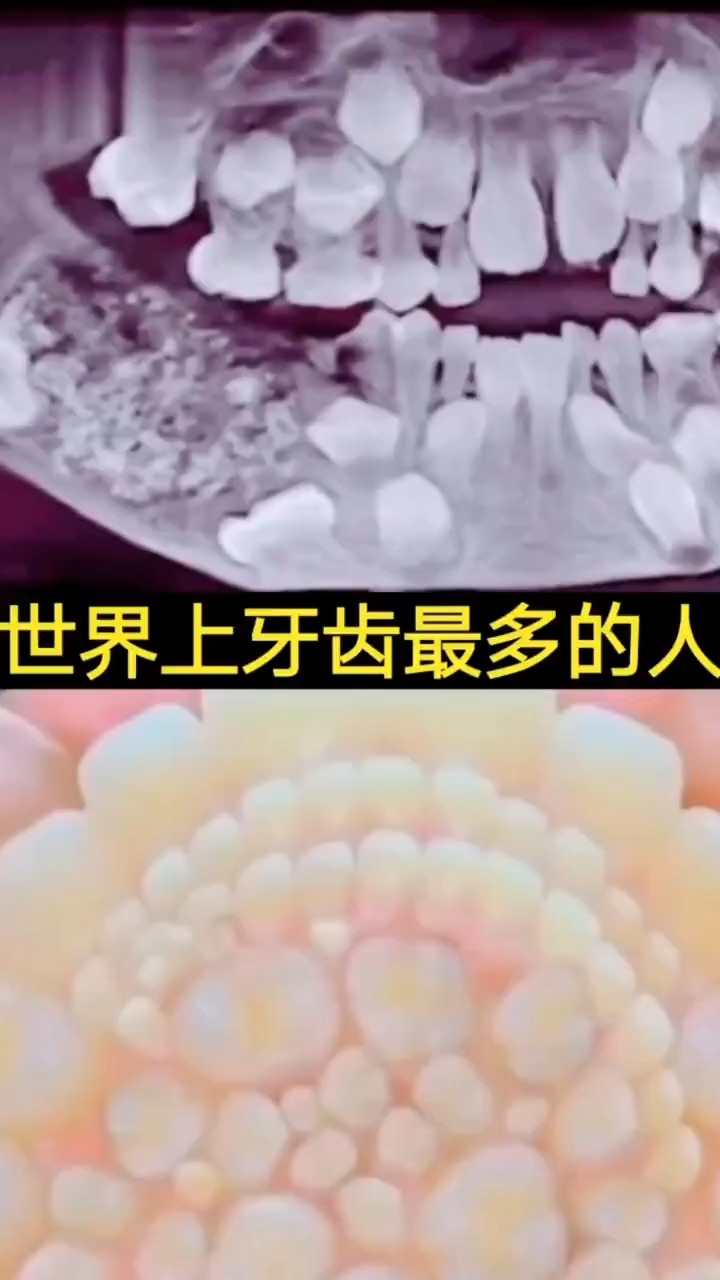 奇闻趣事抢先看#世界上牙齿最多的人