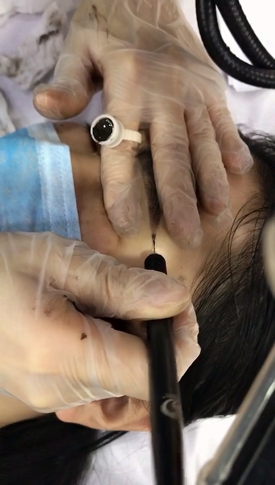 埋针法操作眉尾