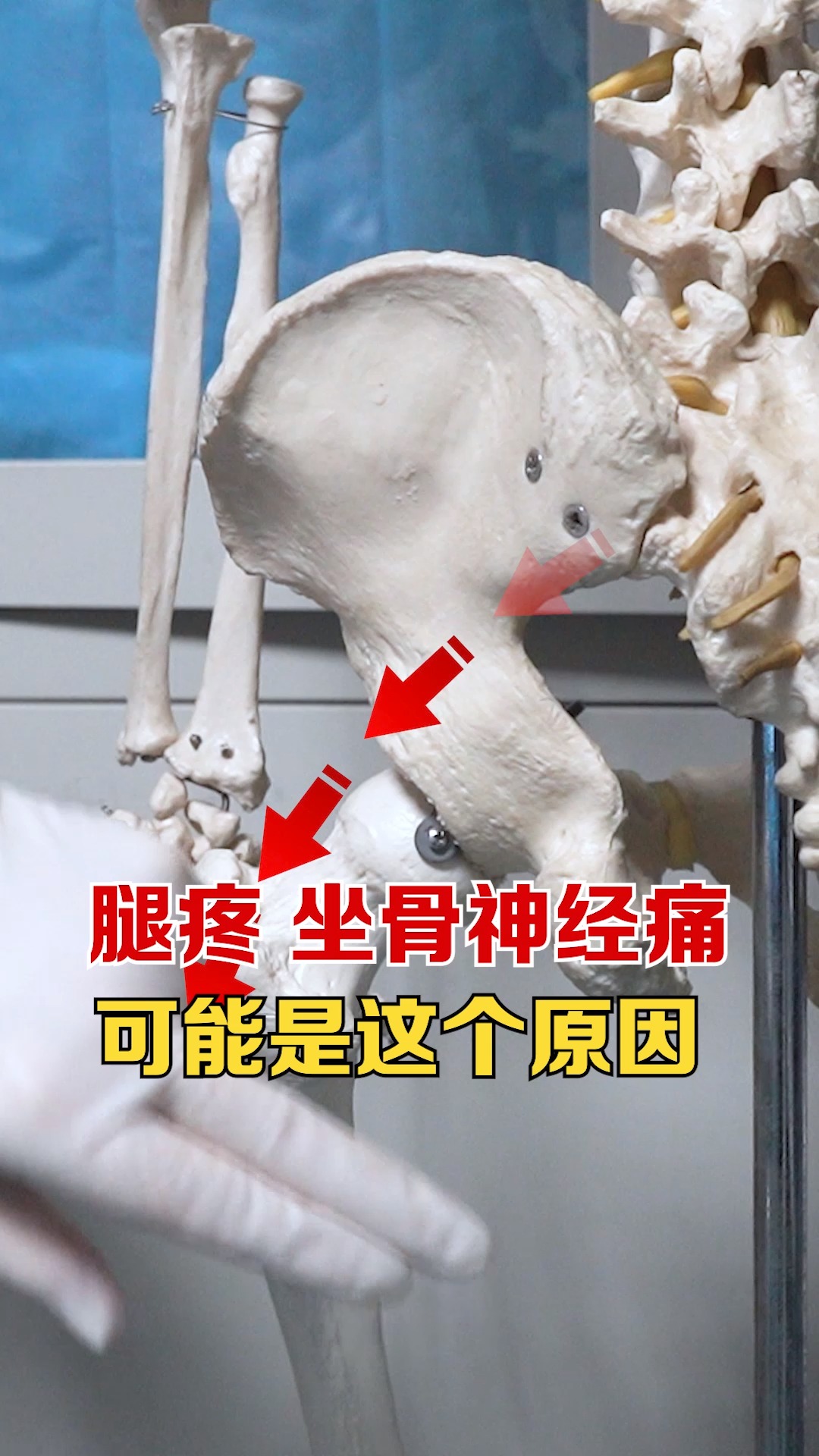 腿疼坐骨神经痛可能是这个原因