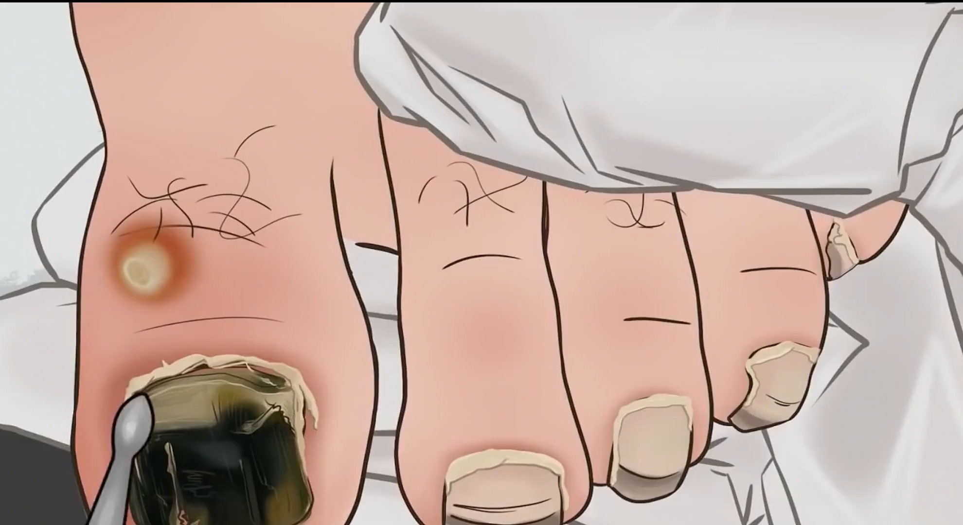 灰指甲用什么药最有效最好能根治,灰指甲断根的最好方法