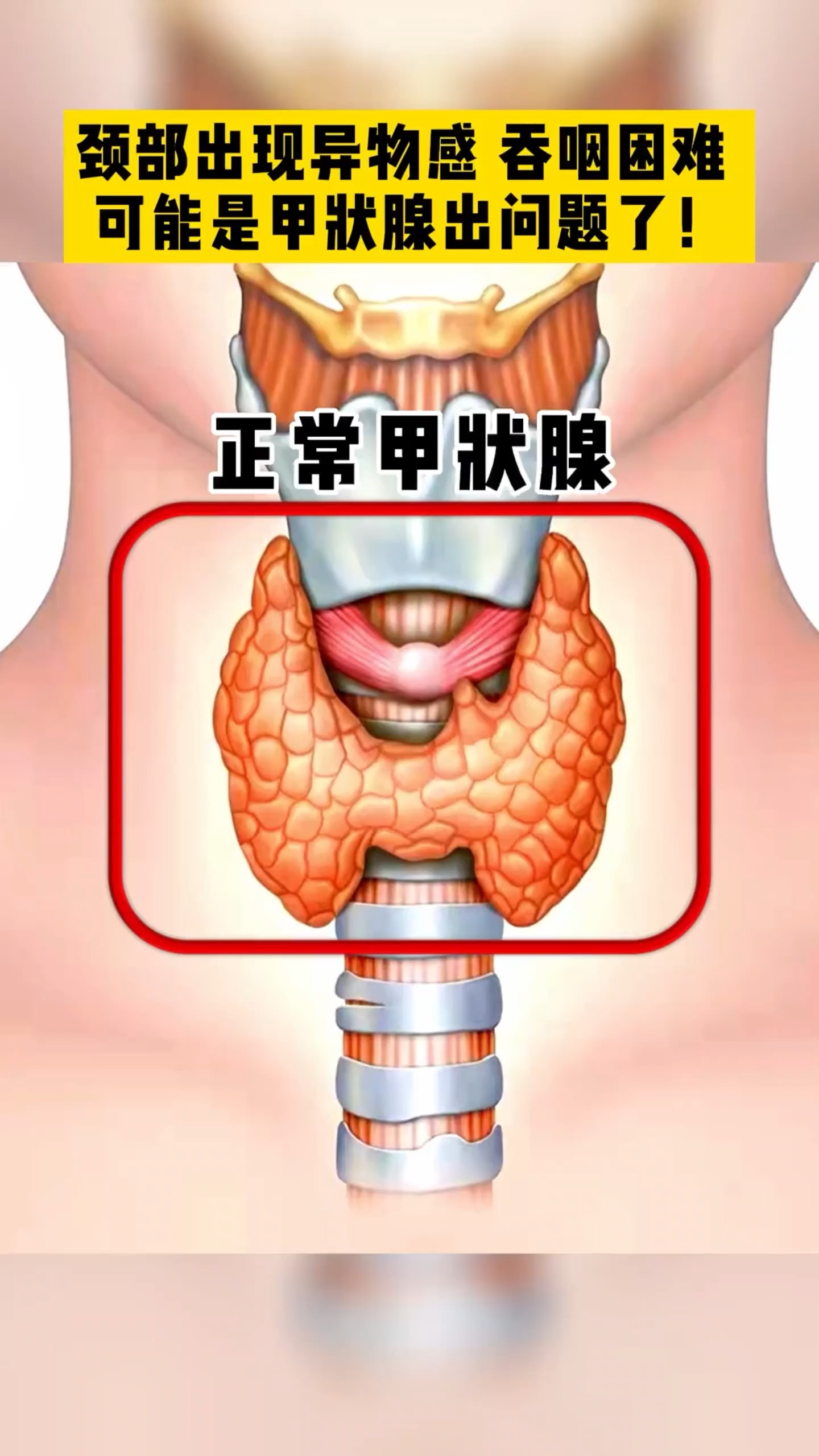 甲状腺结节颈部出现不明原因的异物感应该及时就医