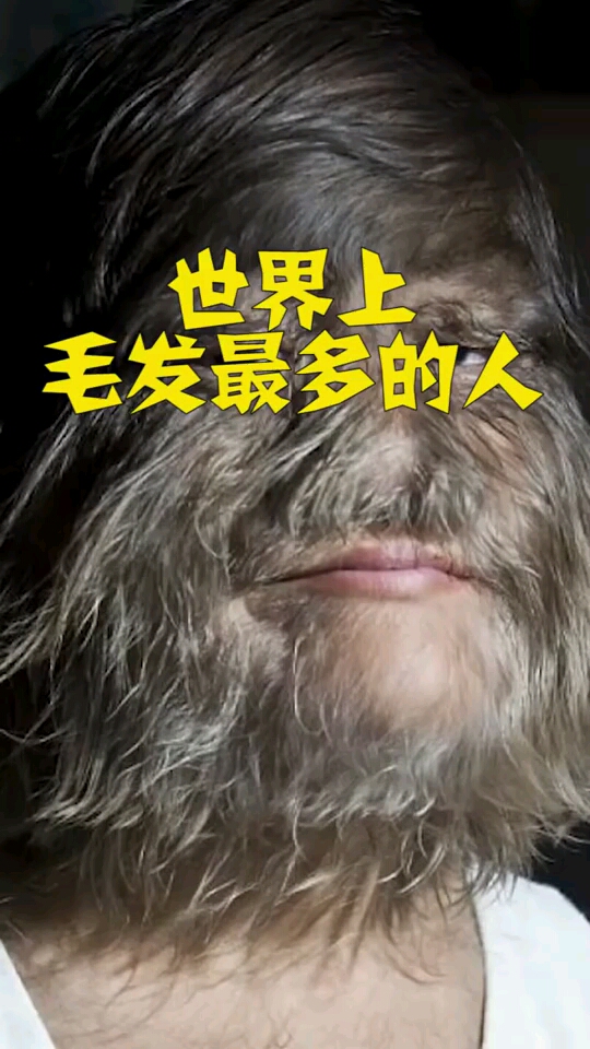 世界上毛发最多的人