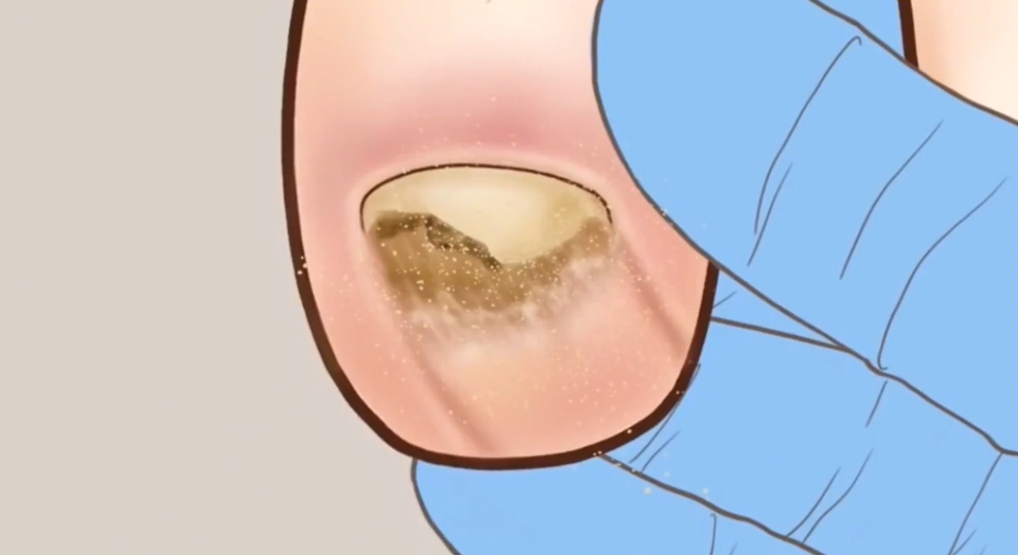 灰指甲怎么根治,灰指甲各个阶段图片