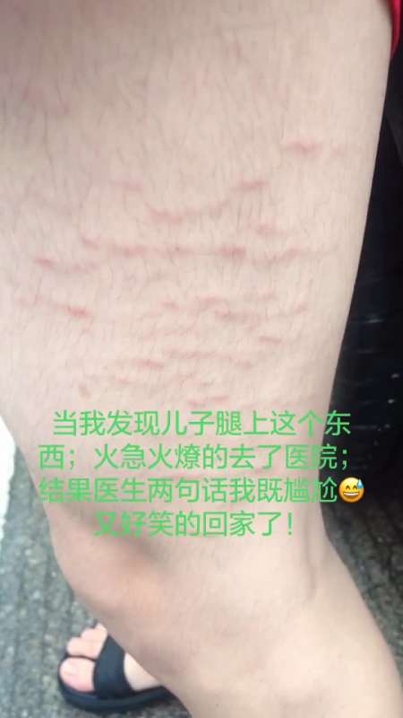 不知道麻麻们有没遇到过这种情况,我反正只知道有妊辰纹?-度小视