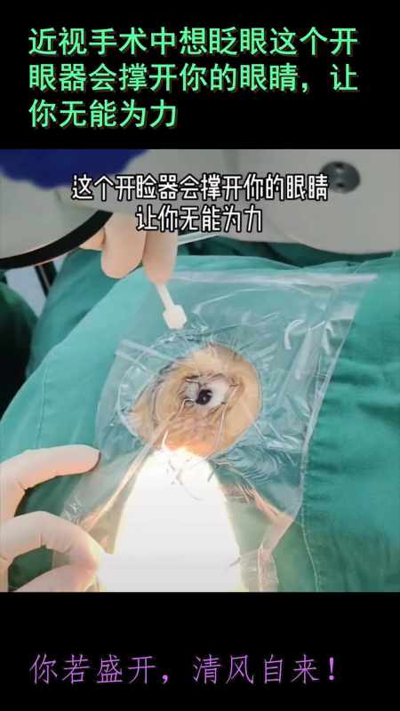 近视手术中想眨眼这个开眼器会撑开你的眼睛,让你无能为力-度小视