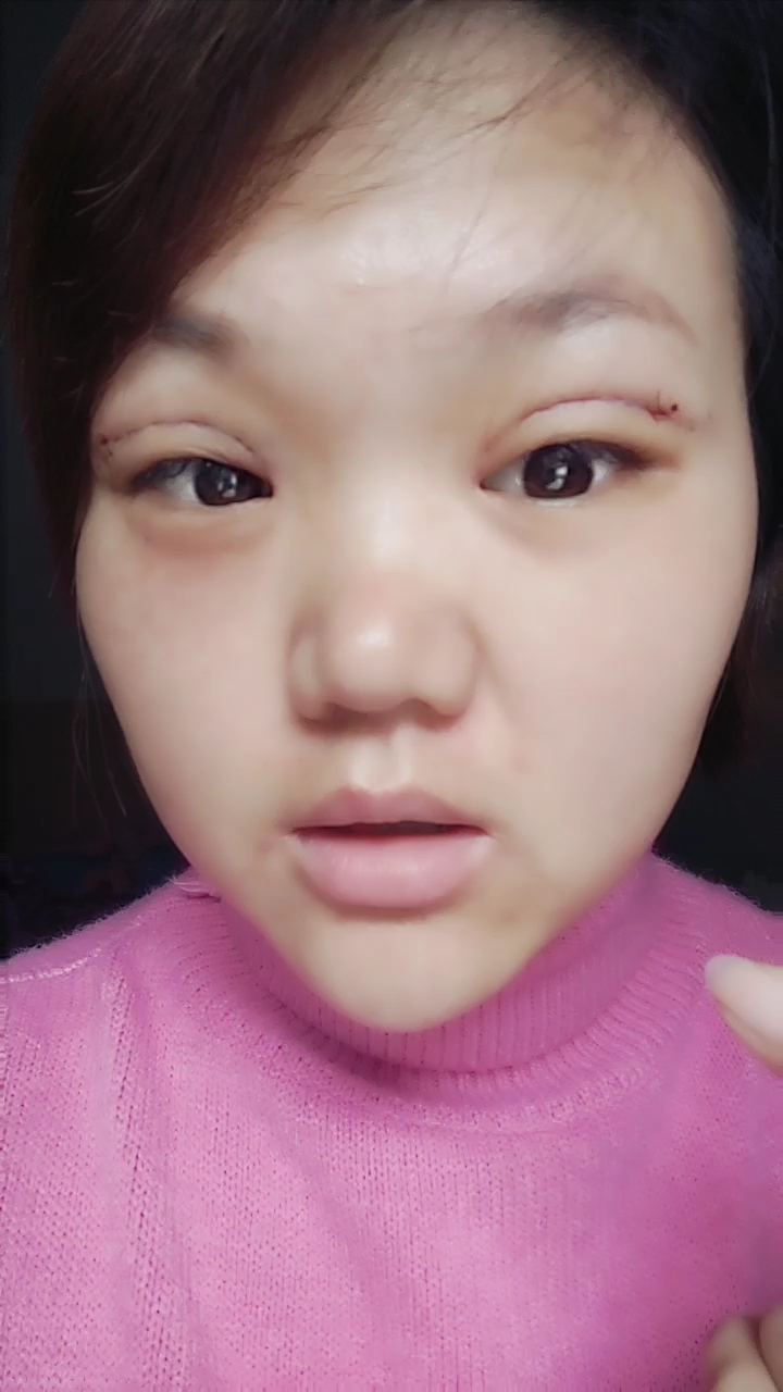 刚做得双眼皮