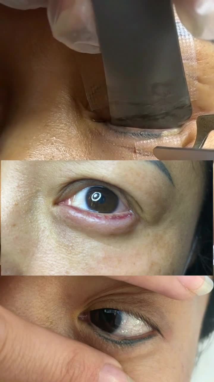 皮秒洗眼线,看你的眼线需要洗几次-度小视