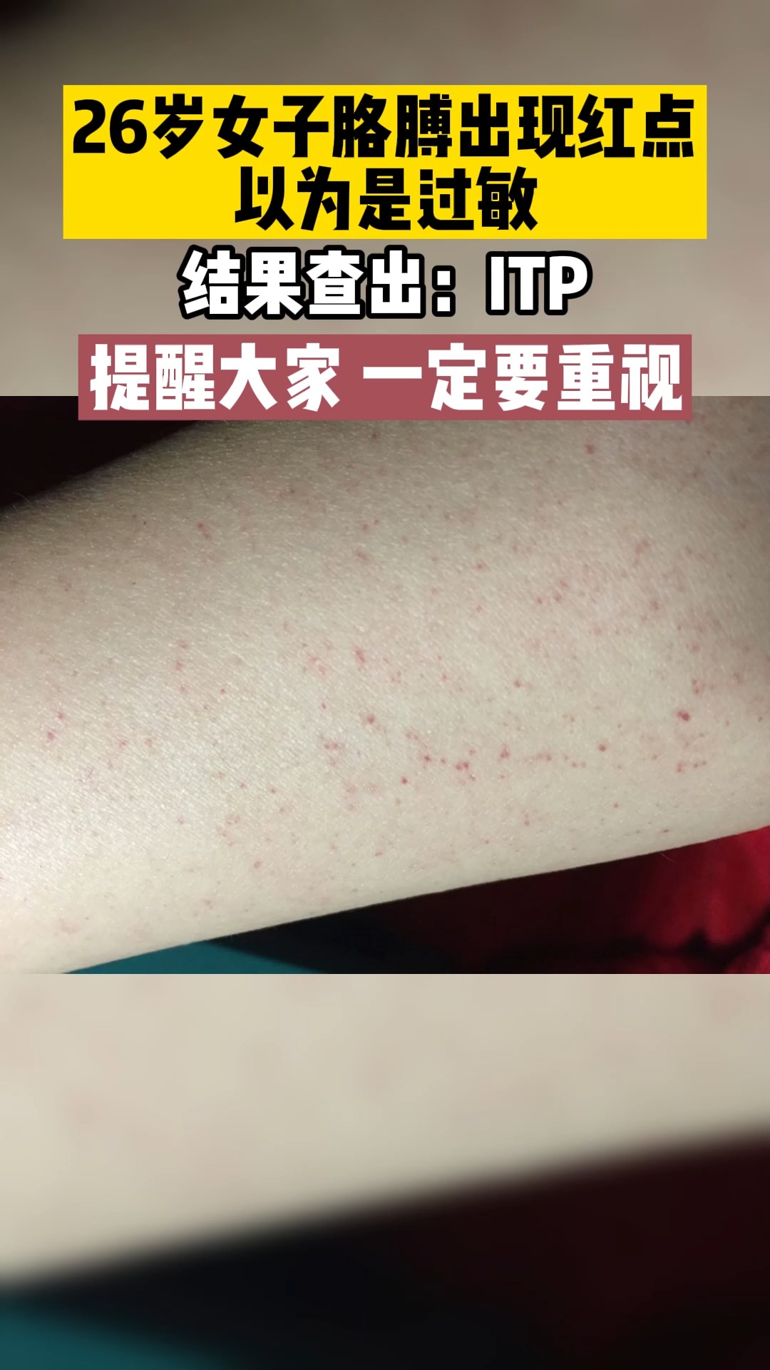 血小板远离血小板减少皮下血点是itp常见症状及时就医不要对号入座