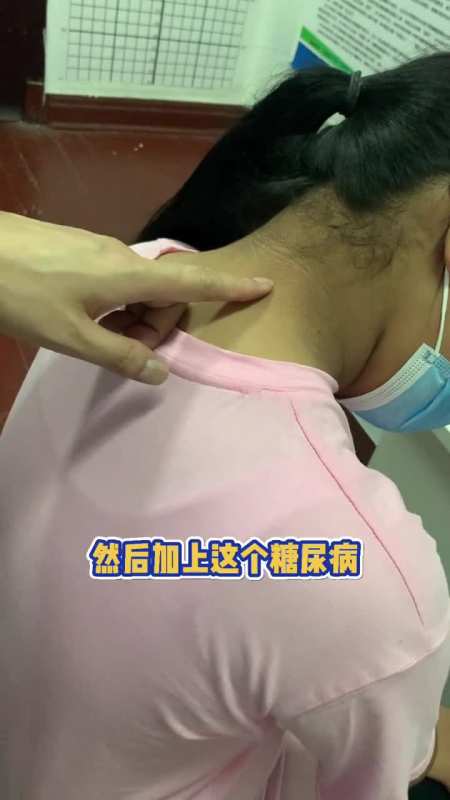 这个13岁黑脖子女孩已经发展到糖尿病阶段了!