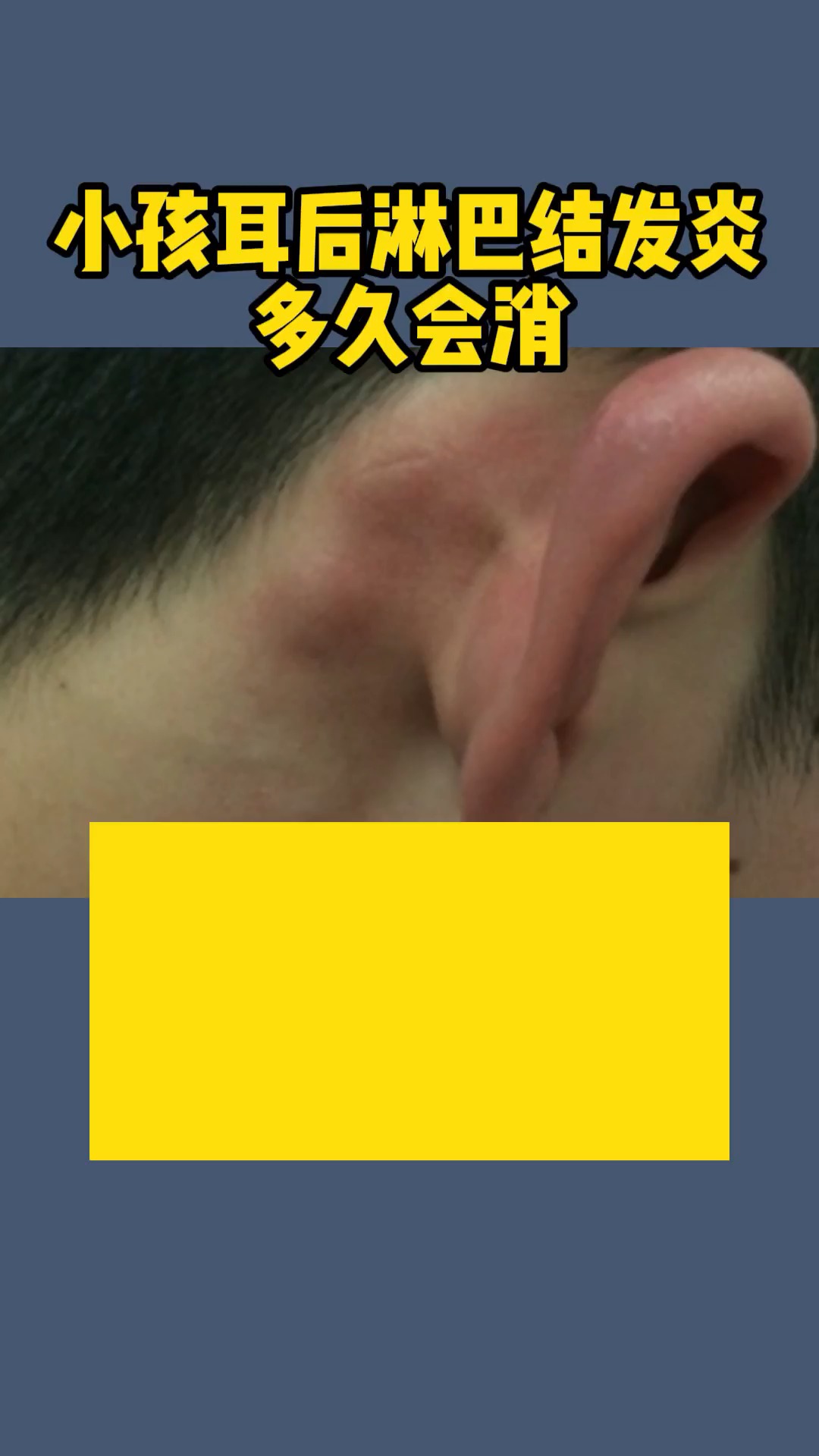 小孩耳后淋巴结发炎多久会消