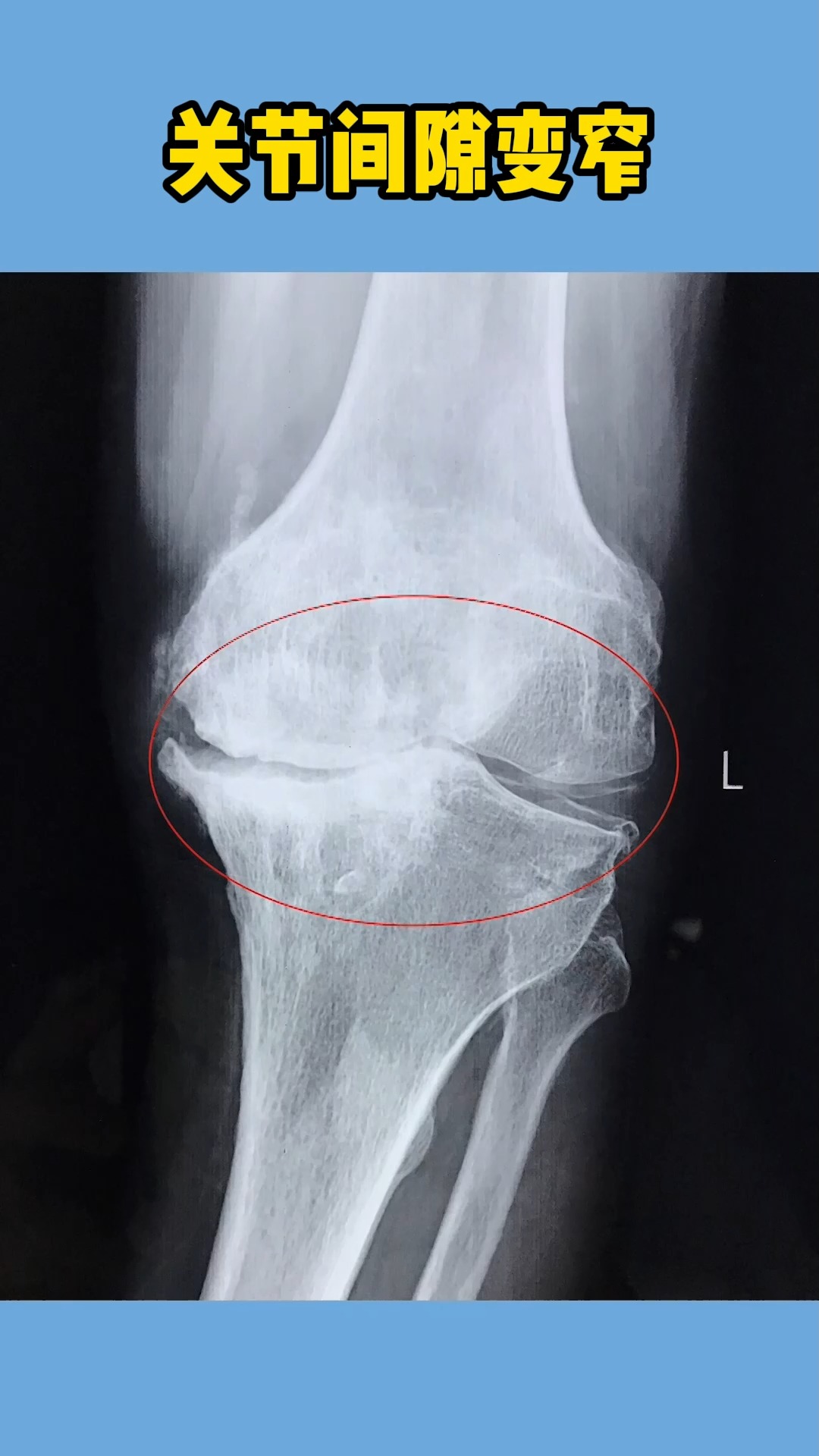 关节间隙变窄,软骨磨损严重