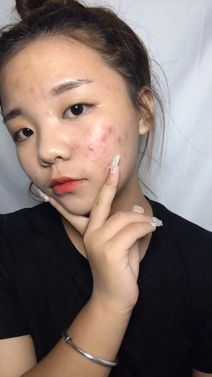 痘痘肌女孩的春天