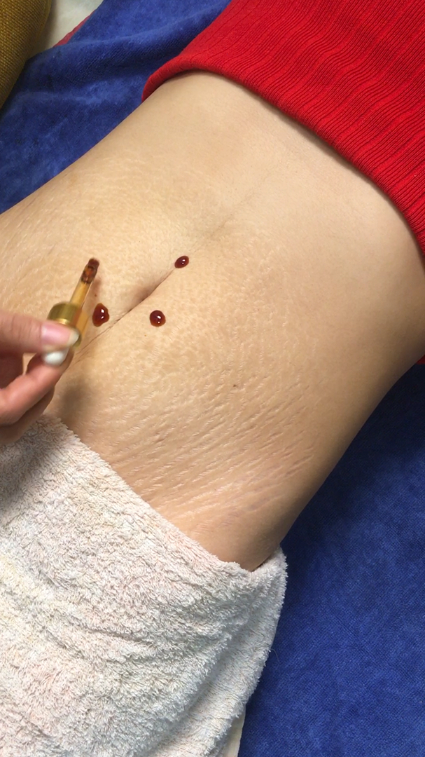 老中医配方,淡化妊娠纹,紧致肌肤.腰围瘦了,还排去湿气