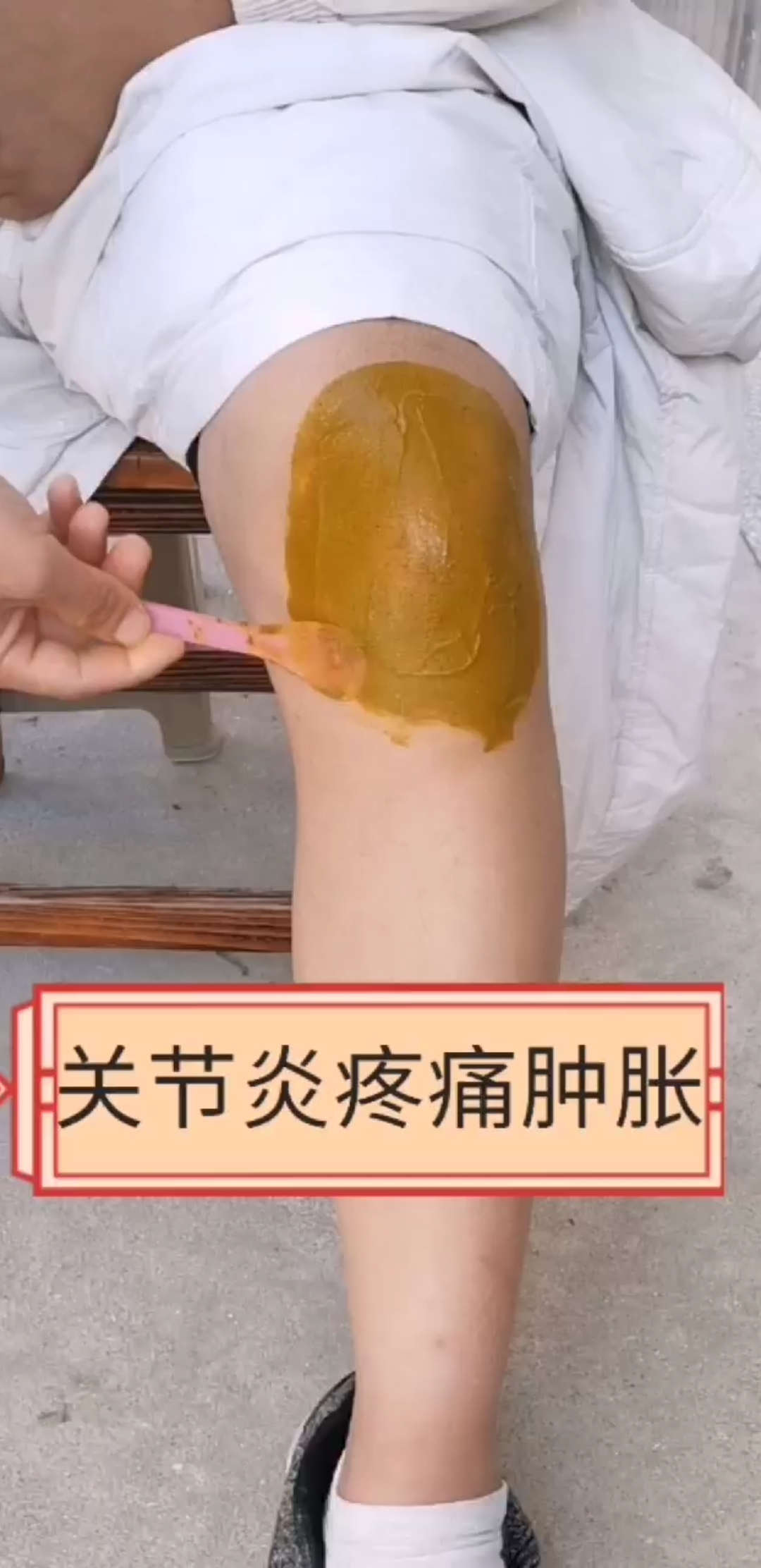 关节炎,膝盖疼痛肿胀