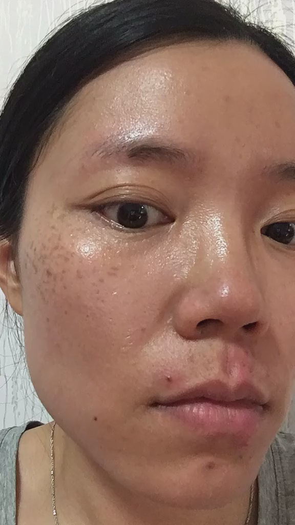 美白祛斑#黑色素就这样消失了!脸上的斑也是同样的原理.