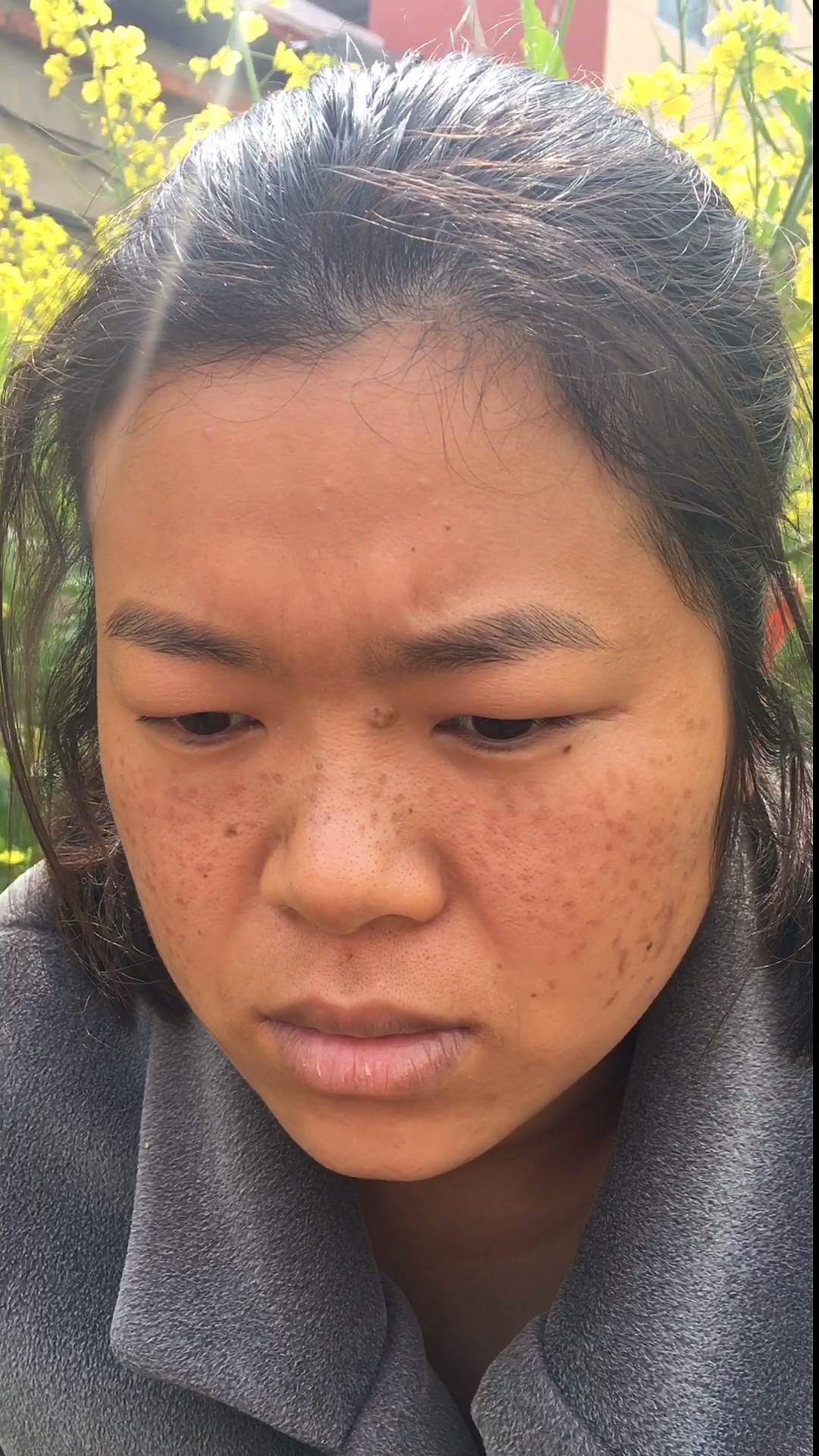 感谢全民我要上热门#八年婚姻,六年麻子脸,两个多月的蜕变,谢谢你